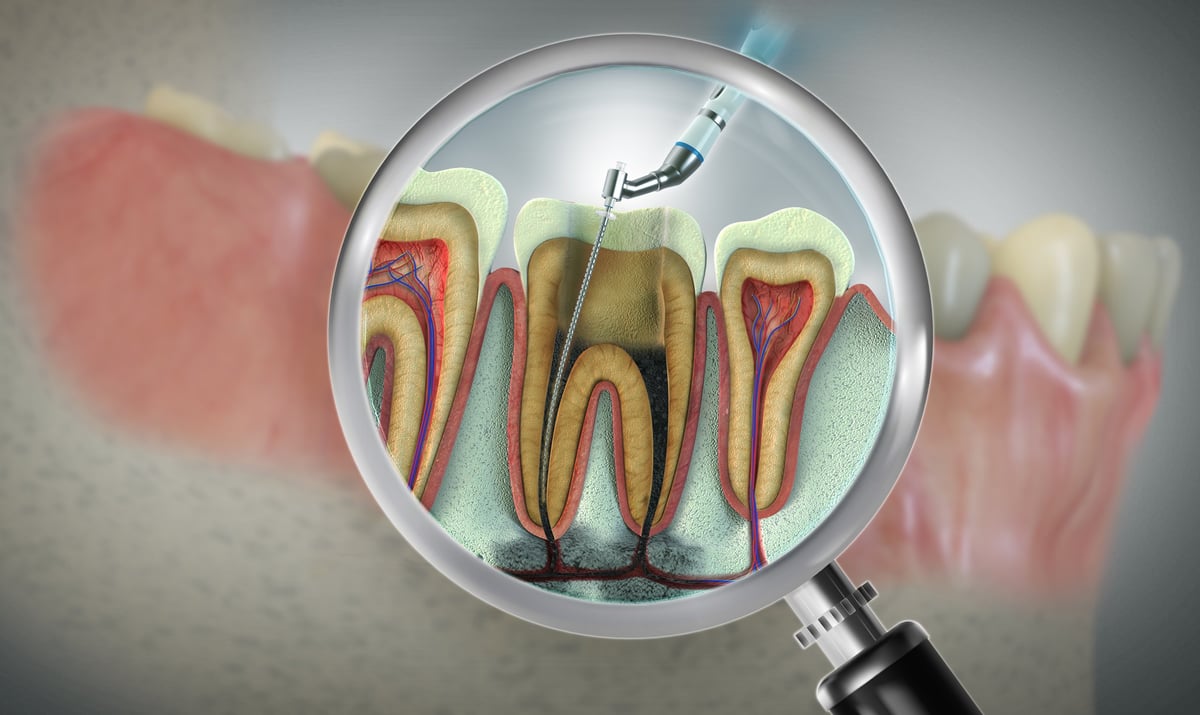 Advanced endodontic file in action removing the infected enamel dentin and some parts of the pulp tissue