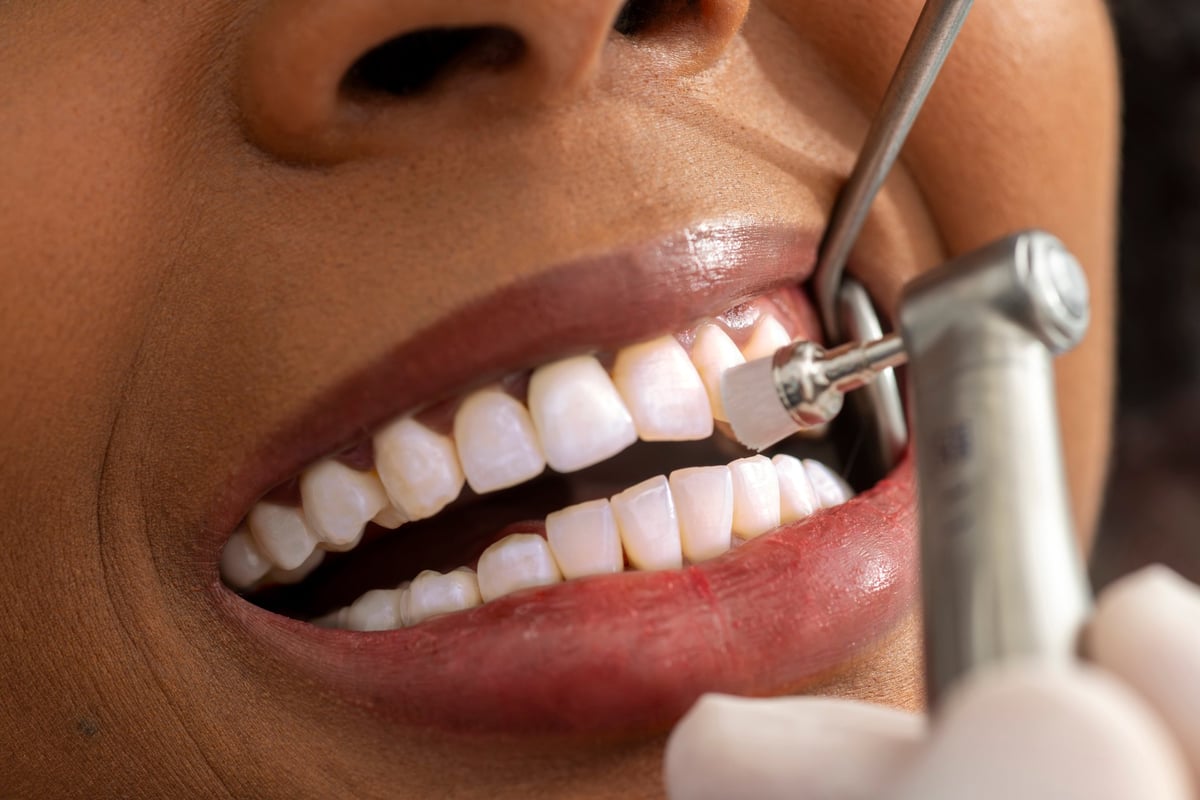 Close up view of a dentist polishing a patient's teeth with a dental drill, highlighting the precision and care in a dental clinic setting
