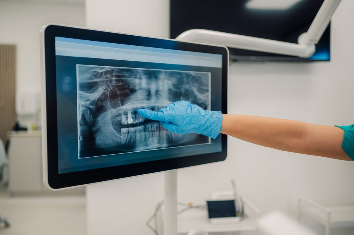 Dentist examining a dental x-ray on a digital monitor, highlighting a specific area of the teeth