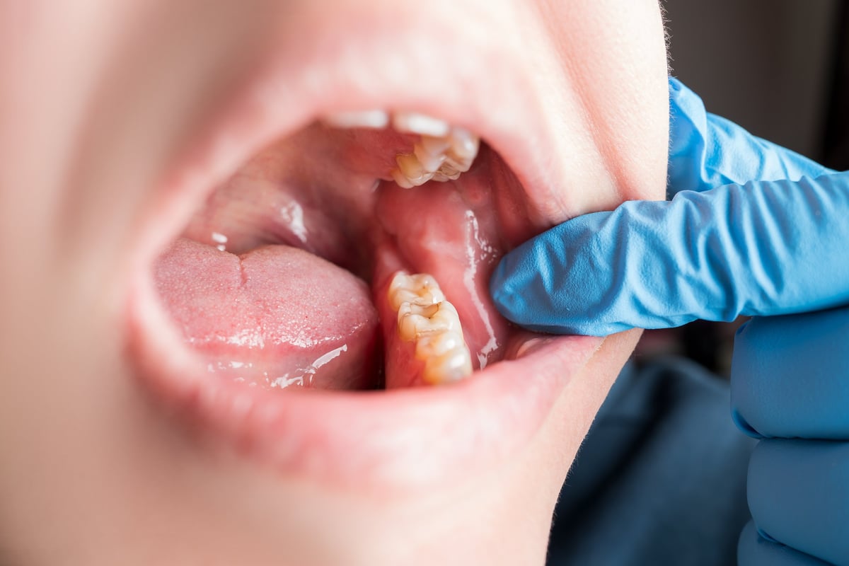 Filling teeth with dental composite photopolymer, tartar, plaque, dental issues and oral health concept closeup