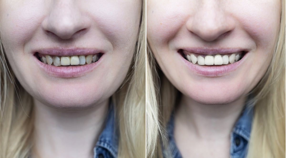 Successful restoration of front incisors. Tooth build-up and reconstruction for a healthy smile. High-quality before and after photos of artistic dental restoration.