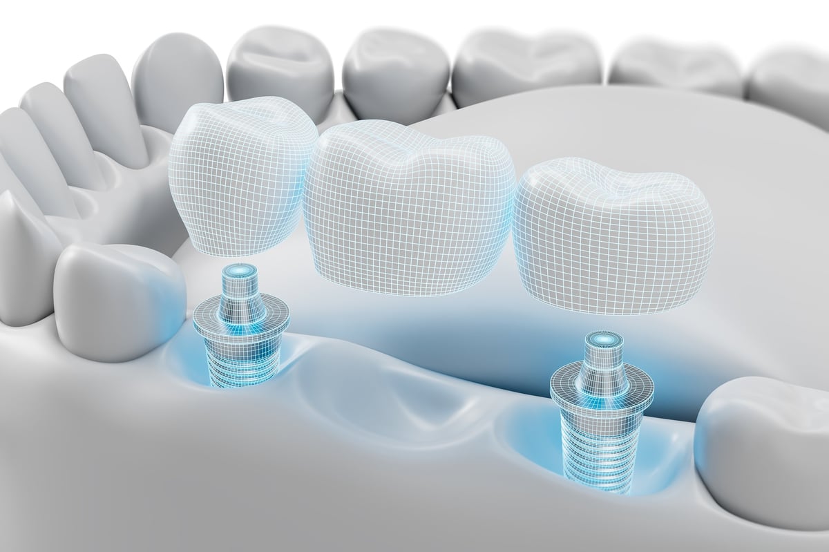 Dental implant bridge structure with 3D modeled artificial teeth and abutments