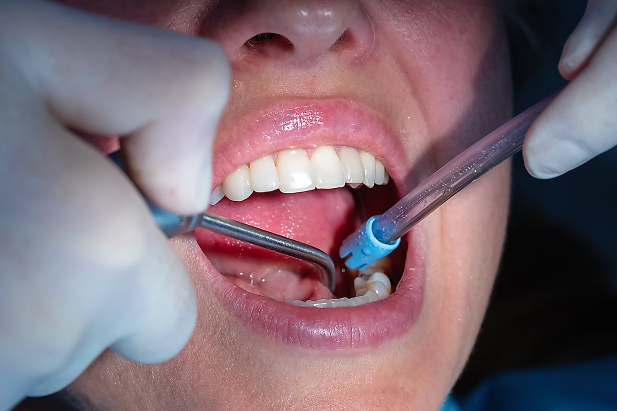 Dentist cleaning and rinsing a prepared tooth before dental crown placement. Close-up of preventive and restorative dentistry procedure in a modern dental clinic.