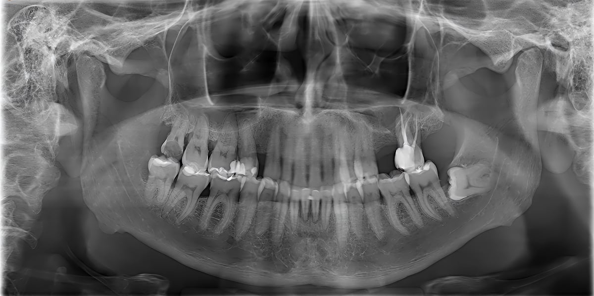 Panoramic dental x-ray displaying human teeth, jawbone, and anatomical structures for diagnostic purposes in dentistry